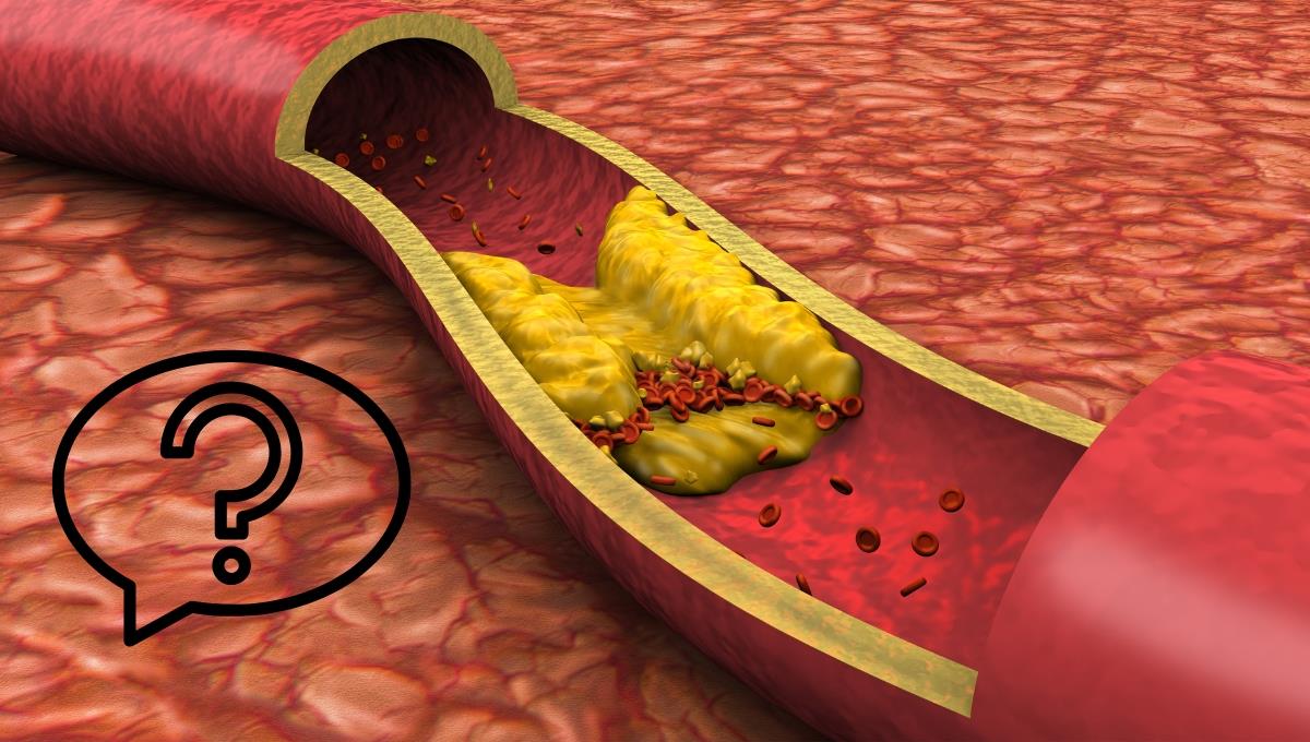 ¿Bypass o stent? La mejor opción para la salud de mujeres con alto colesterol